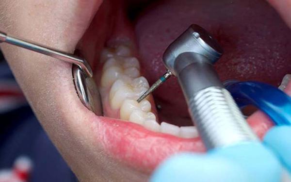 دندان ها پس از عصب کشی چه مدت دوام می آورند؟